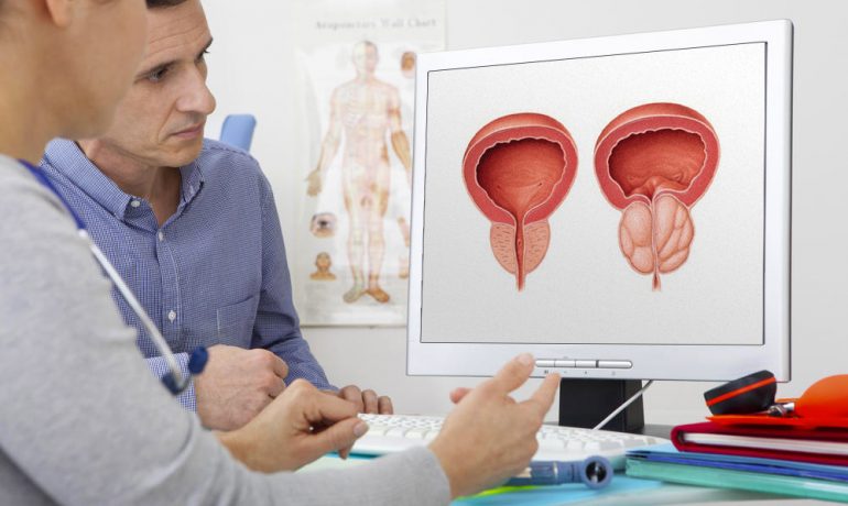 O que é a Hiperplasia Benigna da Próstata?