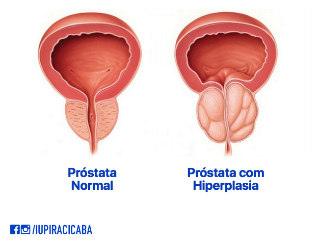 Desenho esquemático de uma Próstata normal e outra apresentando Hiperplasia