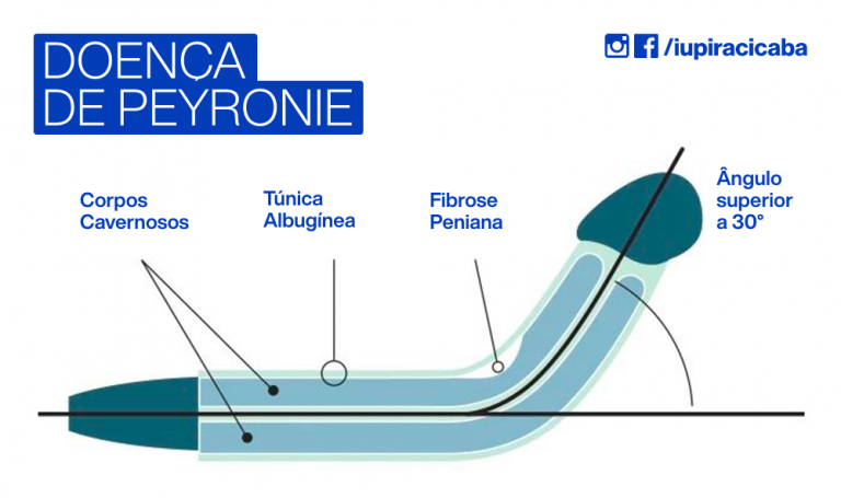 Doença De Peyronie Iup 5691