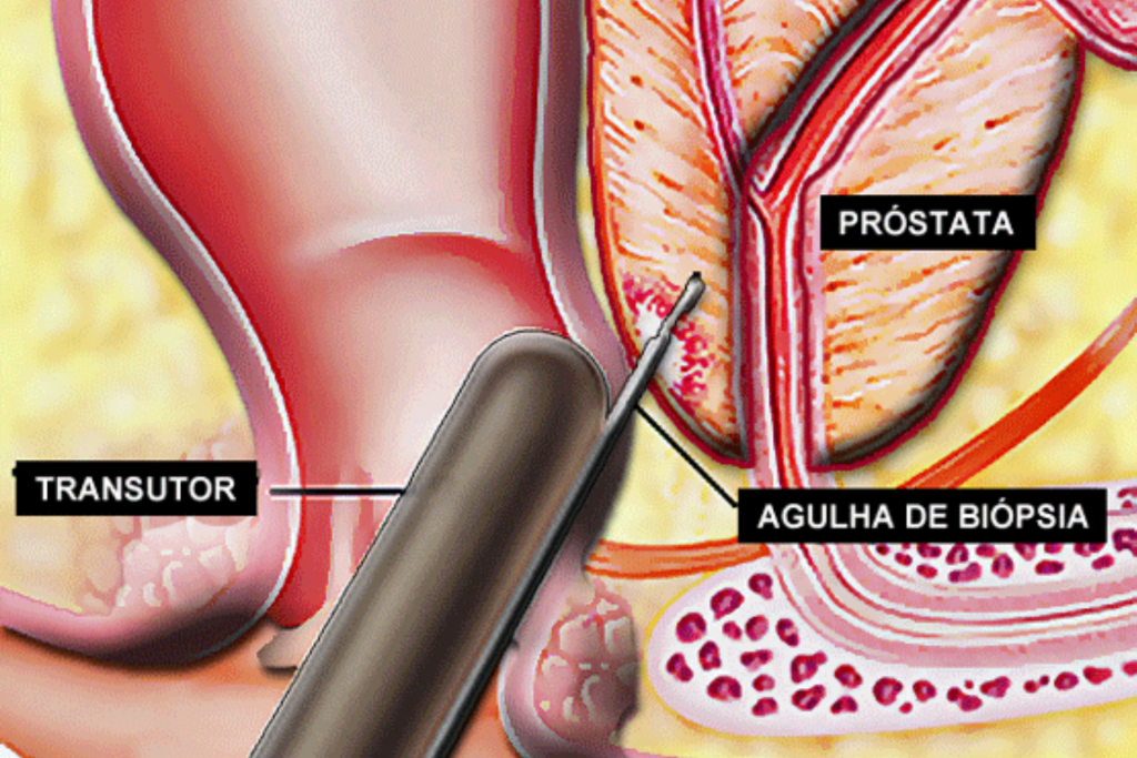 biopsia de próstata que es